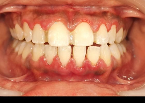 After deep cleaning and scaling at BLR Smiles
