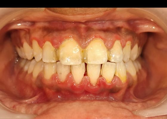 Before deep cleaning and scaling at BLR Smiles