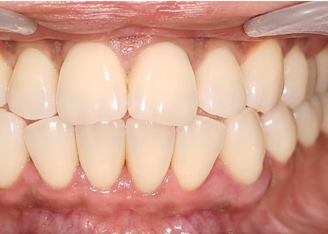 After full smile makeover at BLR Smiles