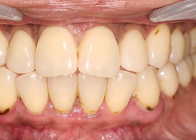 Before full smile makeover at BLR Smiles
