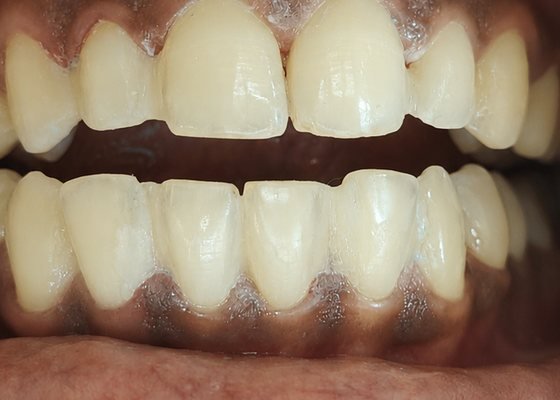 After teeth cleaning and polish at BLR Smiles