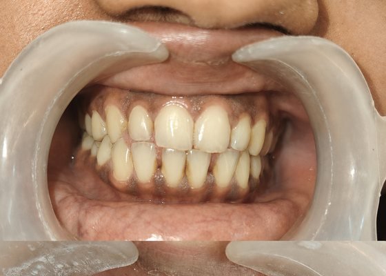 Before teeth cleaning and polish at BLR Smiles