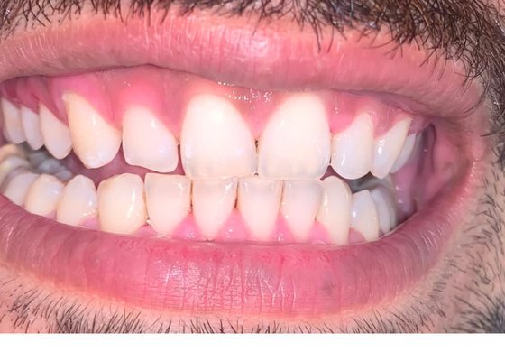 After smile designing at BLR Smiles