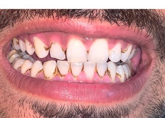 Before smile designing at BLR Smiles