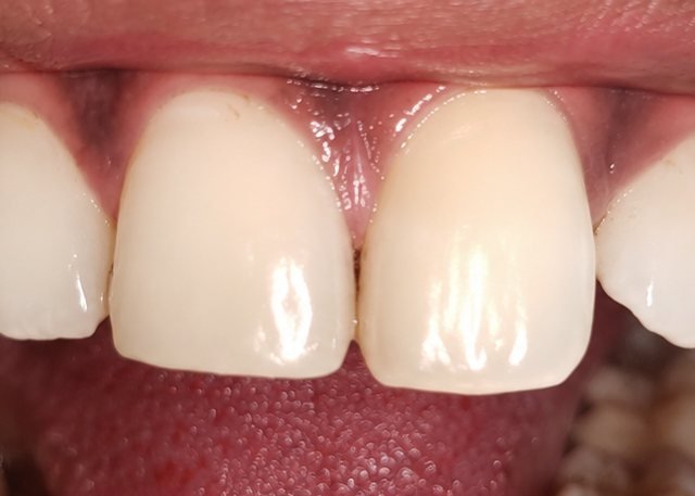 After chipped tooth restoration at BLR Smiles