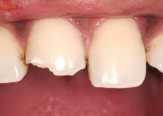 Before chipped tooth restoration at BLR Smiles