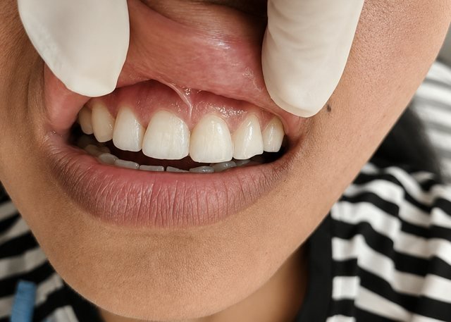 After cosmetic bonding at BLR Smiles