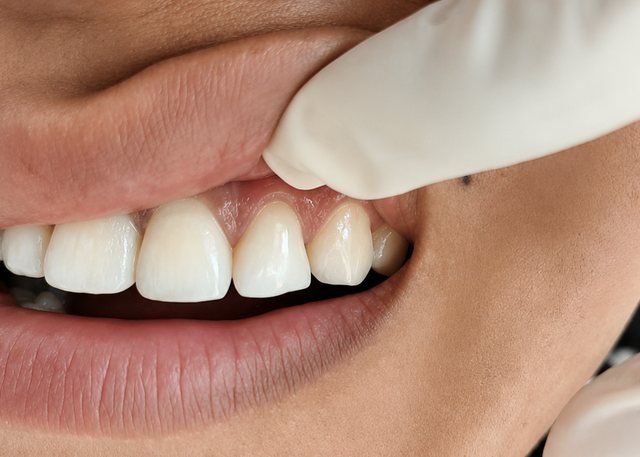 Before cosmetic bonding at BLR Smiles