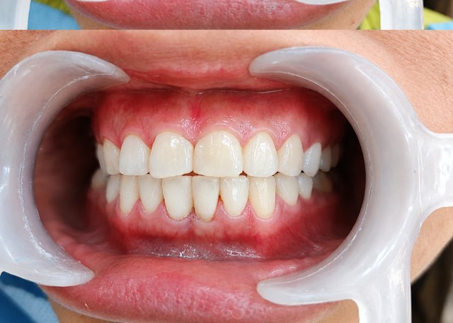 After whitening and polish at BLR Smiles