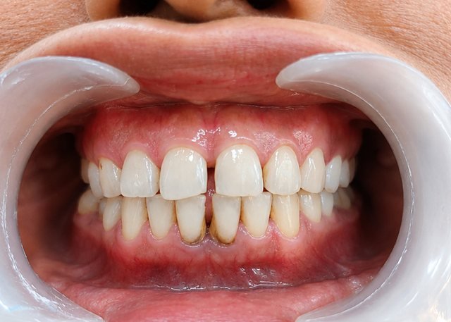 Before whitening and polish at BLR Smiles