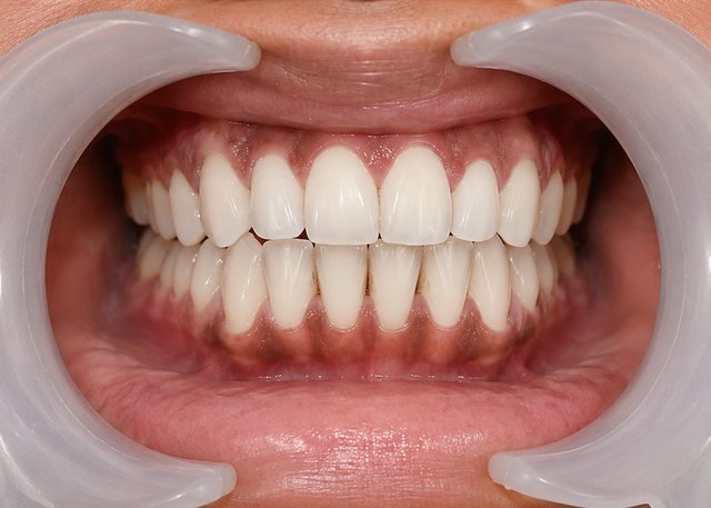 After restorative treatment at BLR Smiles