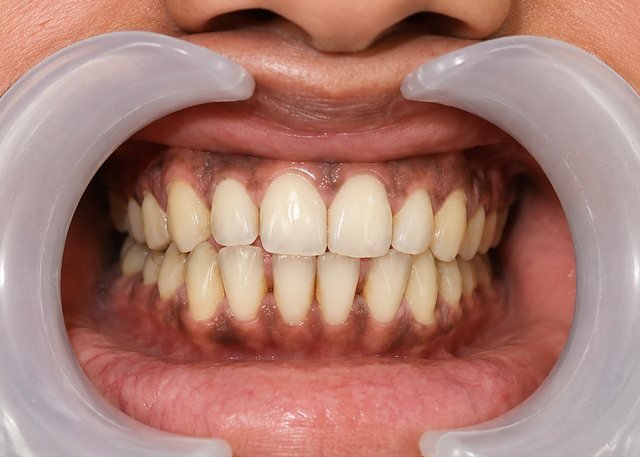 Before restorative treatment at BLR Smiles
