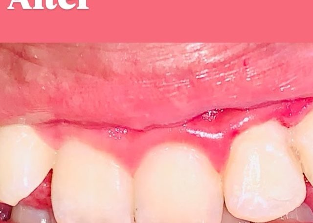 After gum contouring at BLR Smiles