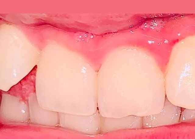 Before gum contouring at BLR Smiles