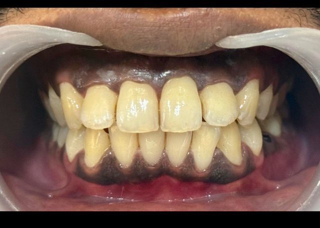 After tobacco and tartar removal at BLR Smiles