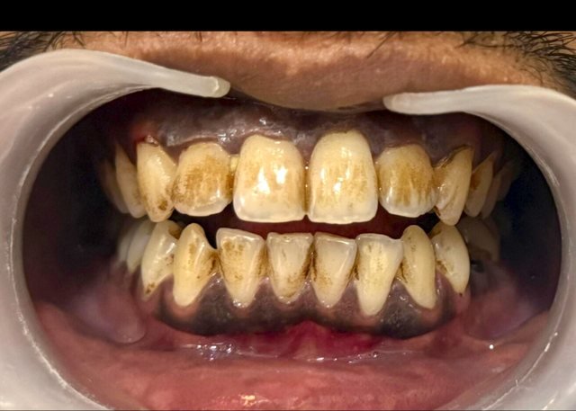 Before tobacco and tartar removal at BLR Smiles